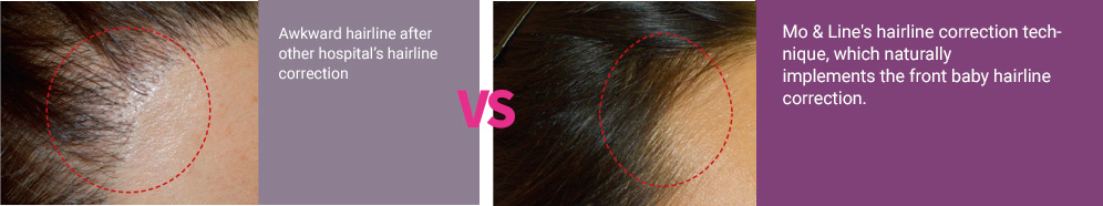 Awkward hairline after other hospital’s hairline correction. VS Mo & Line's hairline correction technique, which naturally implements the front baby hairline correction.