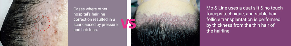 Cases where other hospital's hairline correction resulted in a scar caused by pressure and hair loss. VS Mo & Line uses a dual slit & no-touch forceps technique, and stable hair follicle transplantation is performed by thickness from the thin hair of the hairline.