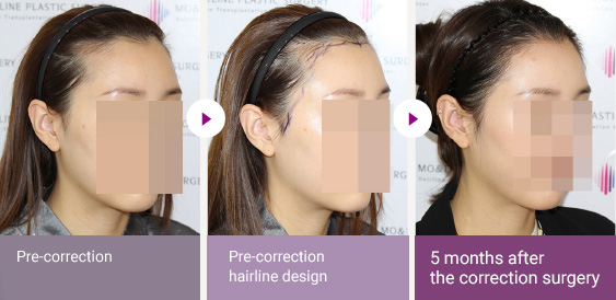 Pre-correction  > Pre-correction hairline design  > 5 months after the correction surgery