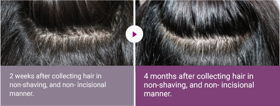 2 weeks after collecting hair in non-shaving, and non- incisional manner. > 4 months after collecting hair in non-shaving, and non- incisional manner.