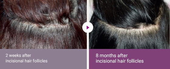 2 weeks after incisional hair follicles > 8 months after incisional hair follicles 