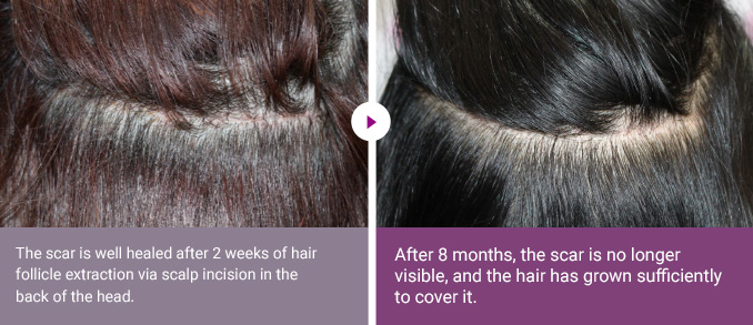 The scar is well healed after 2 weeks of hair follicle extraction via scalp incision in the back of the head. > After 8 months, the scar is no longer visible, and the hair has grown sufficiently to cover it.