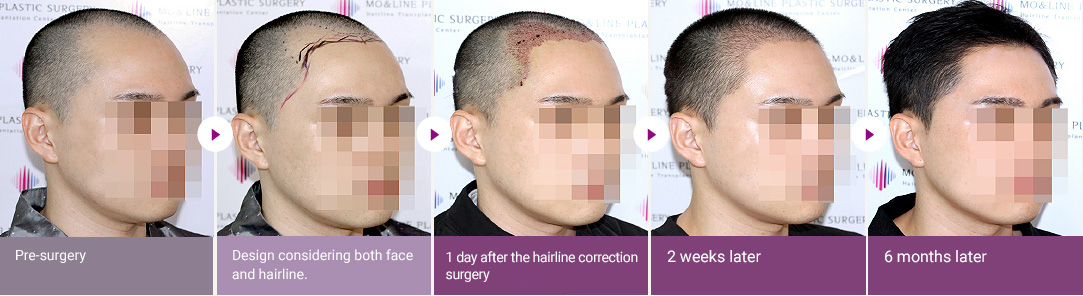 Pre-surgery > Design considering both face and hairline. > 1 day after the hairline correction surgery > 2 weeks later > 6 months later