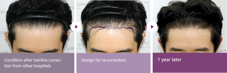 Condition after hairline correction from other hospitals > Design for re-correction >  1 year later