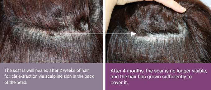 The scar is well healed after 2 weeks of hair follicle extraction via scalp incision in the back of the head. > After 4 months, the scar is no longer visible, and the hair has grown sufficiently to cover it.