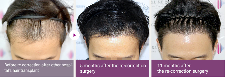 Before re-correction after other hospital’s hair transplant > 5 months after the re-correction surgery > 11 months after  the re-correction surgery