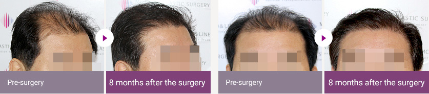 Pre-surgery > 8 months after the surgery / Pre-surgery > 8 months after the surgery