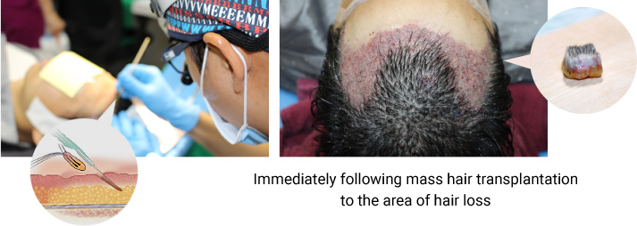 Immediately following mass hair transplantation to the area of hair loss