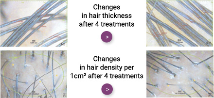 Changes in hair thickness after 4 treatments / Changes in hair density per 1cm² after 4 treatments 