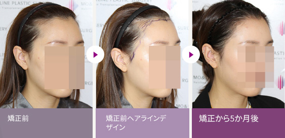 矯正前  > 矯正前ヘアラインデ ザイン  > 矯正から5か月後