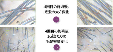 4回目の施術後、毛髪の太さ変化 / 4回目の施術後1㎠当たりの毛髪密度変化