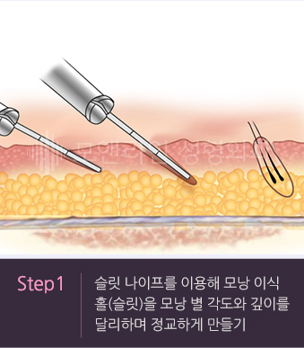 Step1. 슬릿 나이프를 이용해 모낭 이식 홀(슬릿)을 모낭 별 각도와 깊이를 달리하며 정교하게 만들기