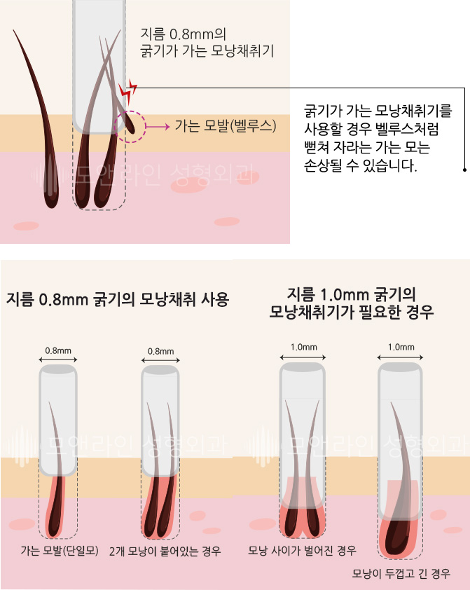 굵기가 가는 모낭채취기를 사용할 경우 벨루스처럼 뻗쳐 자라는 가는 모는 손상될 수 있습니다.