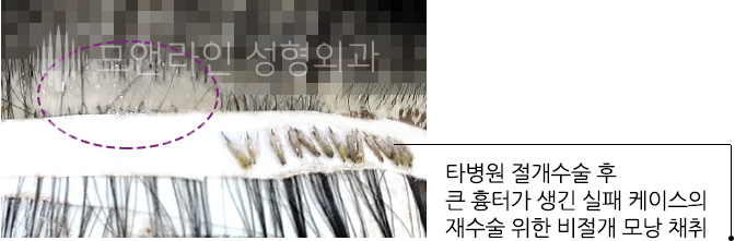 타병원 절개수술 후 큰 흉터가 생긴 실패 케이스의 재수술 위한 비절개 모낭 채취