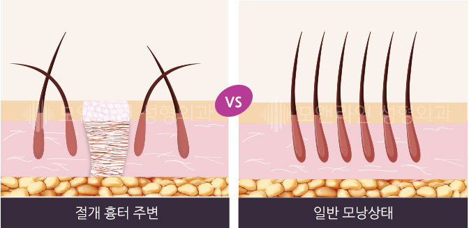 절개 흉터 주번 VS 일반 모낭상태