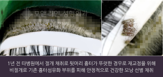 1년 전 타병원에서 절개 채취로 뒷머리 흉터가 뚜렷한 경우로 재교정을 위해 비절개로 기존 흉터섬유화 부위를 피해 안정적으로 건강한 모낭 선별 채취