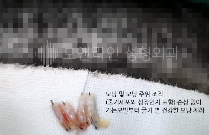 모낭 및 모낭 주위 조직(줄기세포와 성장인자 포함) 손상 없이 가는모발부터 굵기 별 건강한 모낭 채취