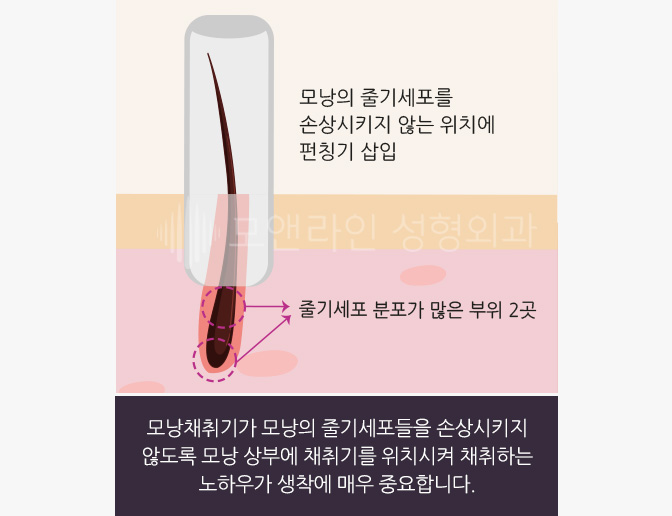 모낭채취기가 모낭의 줄기세포들을 손상시키지 않도록 모낭 상부에 채취기를 위치시켜 채취하는 노하우가 생착에 매우 중요합니다.