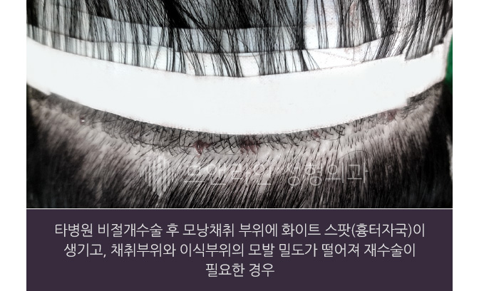 타병원 비절개수술 후 모낭채취 부위에 화이트 스팟(흉터자국)이 생기고, 채취부위와 이식부위의 모발 밀도가 떨어져 재수술이 필요한 경우