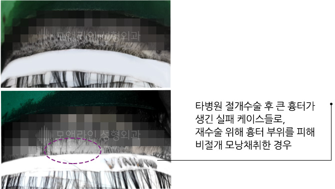 타병원 절개수술 후 큰 흉터가 생긴 실패 케이스들로, 재수술 위해 흉터 부위를 피해 비절개 모낭채취한 경우