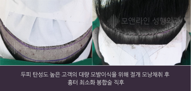 두피 탄성도 높은 고객의 대량 모발이식을 위해 절개 모낭채취 후  흉터 최소화 봉합술 직후