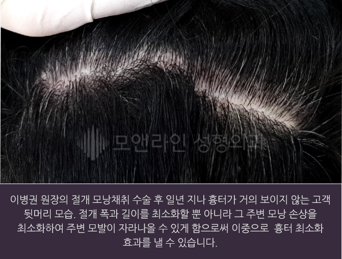 이병권 원장의 절개 모낭채취 수술 후 일년 지나 흉터가 거의 보이지 않는 고객 뒷머리 모습. 절개 폭과 길이를 최소화할 뿐 아니라 그 주변 모낭 손상을 최소화하여 주변 모발이 자라나올 수 있게 함으로써 이중으로  흉터 최소화 효과를 낼 수 있습니다.