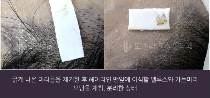 굵게 나온 머리들을 제거한 후 헤어라인 맨앞에 이식할 벨루스와 가는머리 모낭을 채취, 분리한 상태