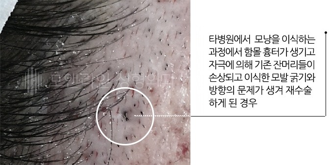 타병원에서 모낭을 이식하는 과정에서 함몰 흉터가 생기고 자극에 의해 기존 잔머리들이 손상되고 이식한 모발 굵기와 방향의 문제가 생겨 재수술 하게 된 경우