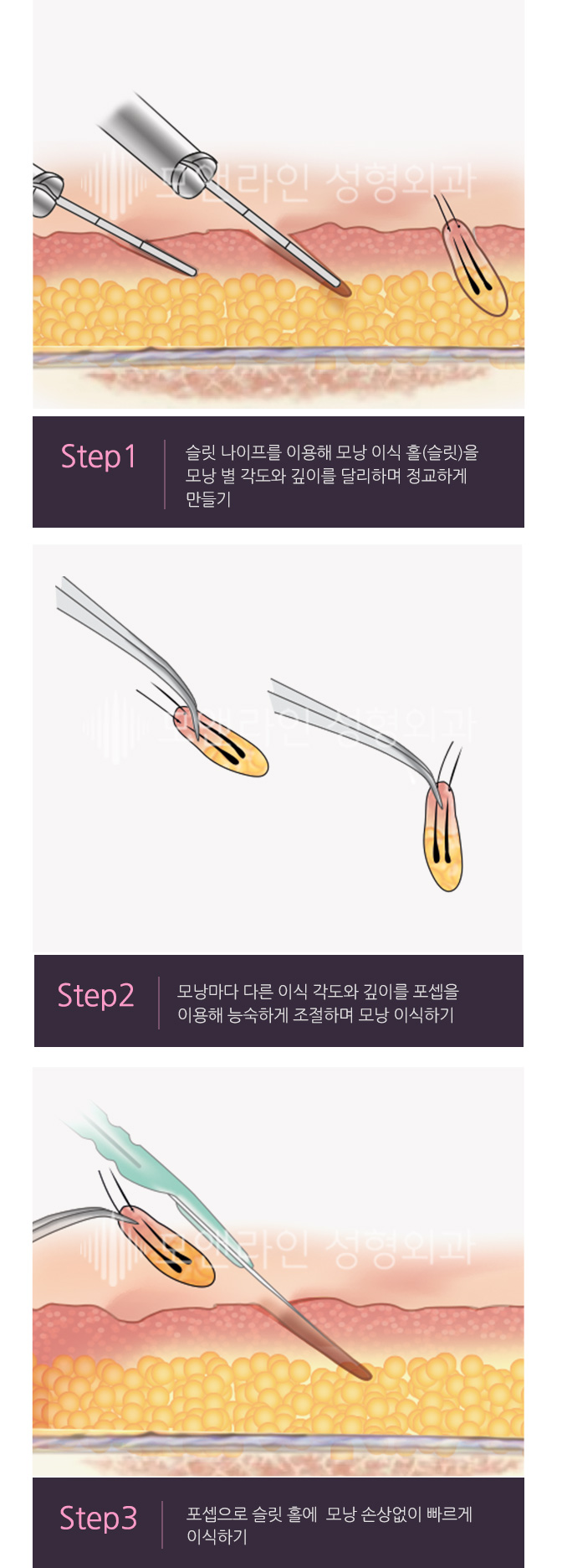 Step1. 슬릿 나이프를 이용해 모낭 이식 홀(슬릿)을 모낭 별 각도와 깊이를 달리하며 정교하게 만들기 / Step2. 모낭마다 다른 이식 각도와 깊이를 포셉을 이용해 능숙하게 조절하며 모낭 이식하기 / Step3. 포셉으로 슬릿 홀에  모낭 손상없이 빠르게 이식하기