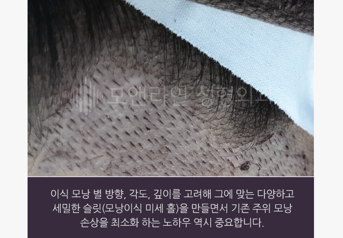 이식 모낭 별 방향, 각도, 깊이를 고려해 그에 맞는 다양하고 세밀한 슬릿(모낭이식 미세 홀)을 만들면서 기존 주위 모낭 손상을 최소화 하는 노하우 역시 중요합니다.