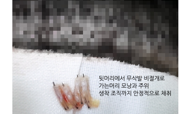 뒷머리에서 무삭발 비절개로 가는머리 모낭과 주위 생착 조직까지 안정적으로 채취