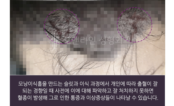 모낭이식홀을 만드는 슬릿과 이식 과정에서 개인에 따라 출혈이 잘 되는 경향일 때 사전에 이에 대해 파악하고 잘 처치하지 못하면 혈종이 발생해 그로 인한 통증과 이상증상들이 나타날 수 있습니다.