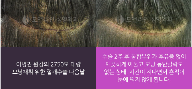 이병권 원장의 2750모 대량 모낭채취 위한 절개수술 다음날 / 수술 2주 후 봉합부위가 후유증 없이 깨끗하게 아물고 모낭 동반탈락도 없는 상태. 시간이 지나면서 흔적이 눈에 띄지 않게 됩니다.