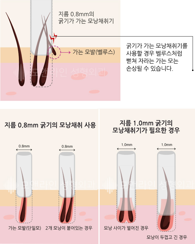 굵기가 가는 모낭채취기를 사용할 경우 벨루스처럼 뻗쳐 자라는 가는 모는 손상될 수 있습니다.