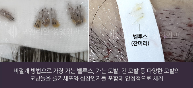 비절개 방법으로 가장 가는 벨루스, 가는 모발, 긴 모발 등 다양한 모발의 모낭들을 줄기세포와 성장인자를 포함해 안정적으로 채취