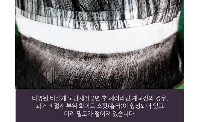 타병원 비절개 모낭채취 2년 후 헤어라인 재교정의 경우. 과거 비절개 부위 화이트 스팟(흉터)이 형성되어 있고 머리 밀도가 떨어져 있습니다.