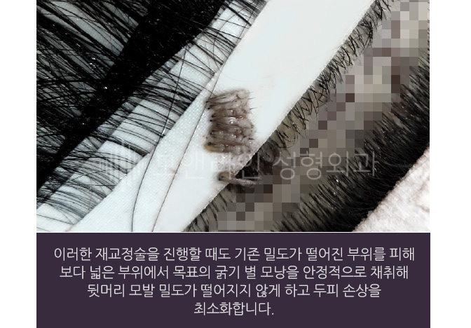 이러한 재교정술을 진행할 때도 기존 밀도가 떨어진 부위를 피해 보다 넓은 부위에서 목표의 굵기 별 모낭을 안정적으로 채취해 뒷머리 모발 밀도가 떨어지지 않게 하고 두피 손상을 최소화합니다.