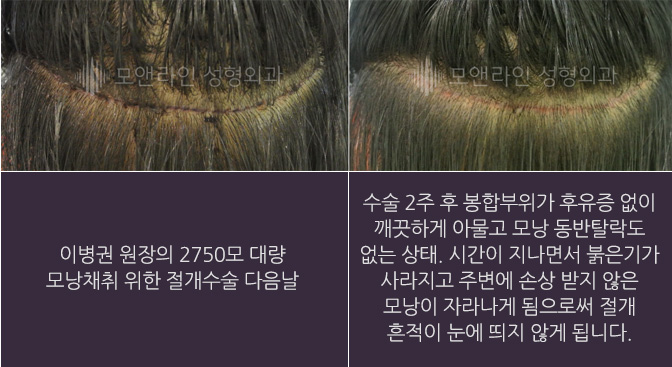 이병권 원장의 2750모 대량 모낭채취 위한 절개수술 다음날 / 수술 2주 후 봉합부위가 후유증 없이 깨끗하게 아물고 모낭 동반탈락도 없는 상태. 시간이 지나면서 붉은기가 사라지고 주변에 손상 받지 않은 모낭이 자라나게 됨으로써 절개 흔적이 눈에 띄지 않게 됩니다.