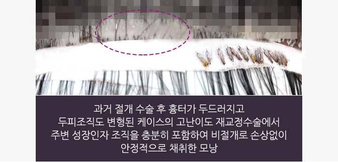 과거 절개 수술 후 흉터가 두드러지고 두피조직도 변형된 케이스의 고난이도 재교정수술에서 주변 성장인자 조직을 충분히 포함하여 비절개로 손상없이 안정적으로 채취한 모낭