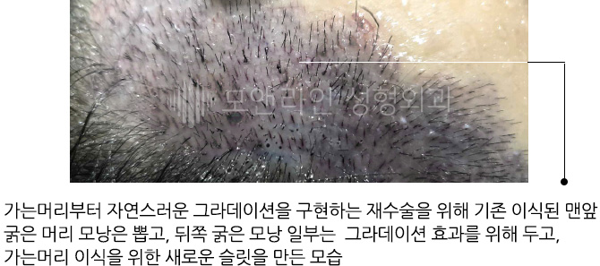 가는머리부터 자연스러운 그라데이션을 구현하는 재수술을 위해 기존 이식된 맨앞 굵은 머리 모낭은 뽑고, 뒤쪽 굵은 모낭 일부는 그라데이션 효과를 위해 두고, 가는머리 이식을 위한 새로운 슬릿을 만든 모습