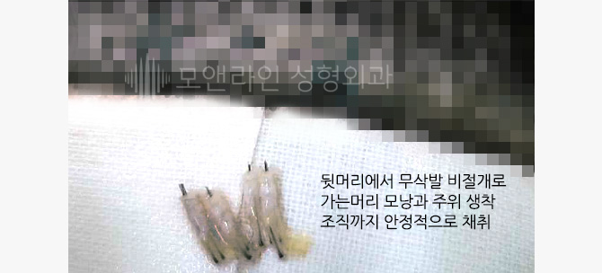 뒷머리에서 무삭발 비절개로 가는머리 모낭과 주위 생착 조직까지 안정적으로 채취