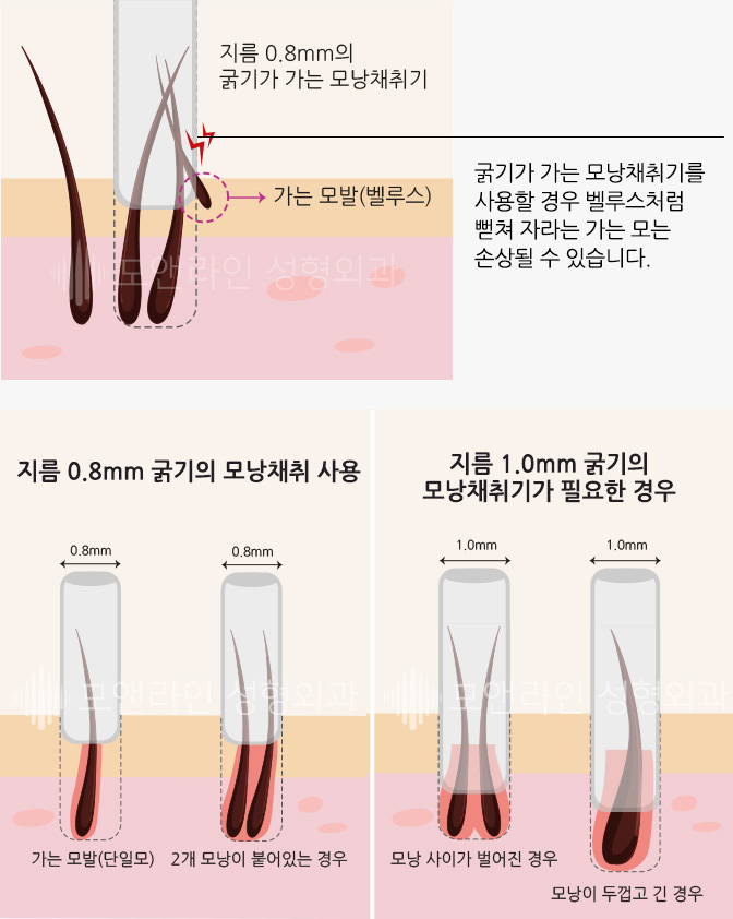 굵기가 가는 모낭채취기를 사용할 경우 벨루스처럼 뻗쳐 자라는 가는 모는 손상될 수 있습니다.