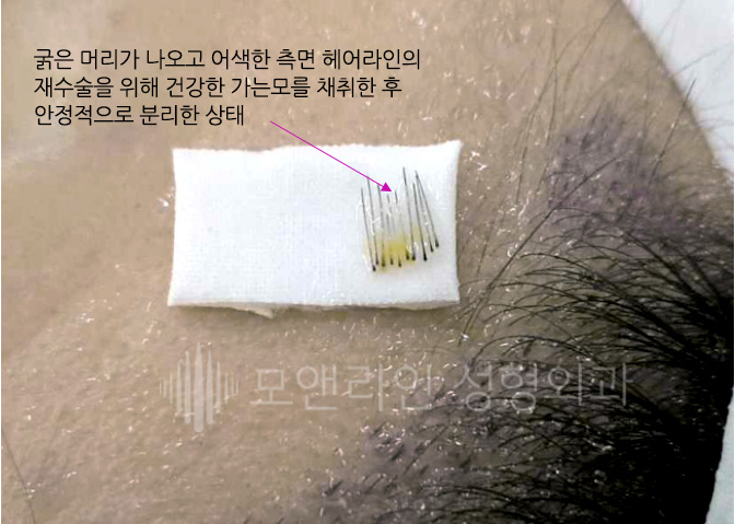 수술 후 통증과 흉터를 최소화하는 데 필요한 성형외과적 연속봉합 노하우