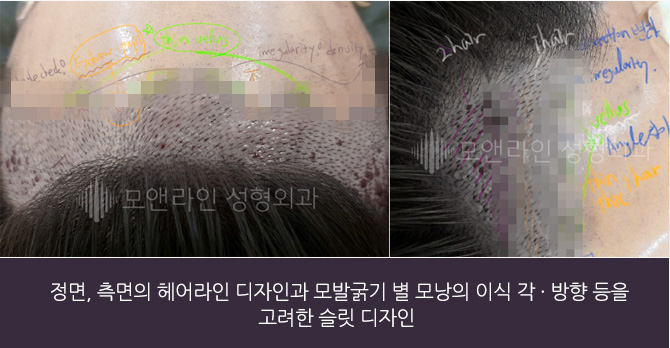 정면, 측면의 헤어라인 디자인과 모발굵기 별 모낭의 이식 각 · 방향 등을 고려한 슬릿 디자인