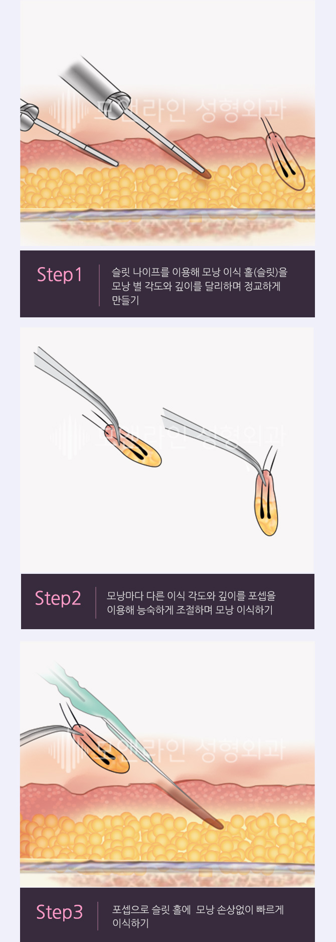 Step1. 슬릿 나이프를 이용해 모낭 이식 홀(슬릿)을 모낭 별 각도와 깊이를 달리하며 정교하게 만들기 / Step2. 모낭마다 다른 이식 각도와 깊이를 포셉을 이용해 능숙하게 조절하며 모낭 이식하기 / Step3. 포셉으로 슬릿 홀에  모낭 손상없이 빠르게 이식하기