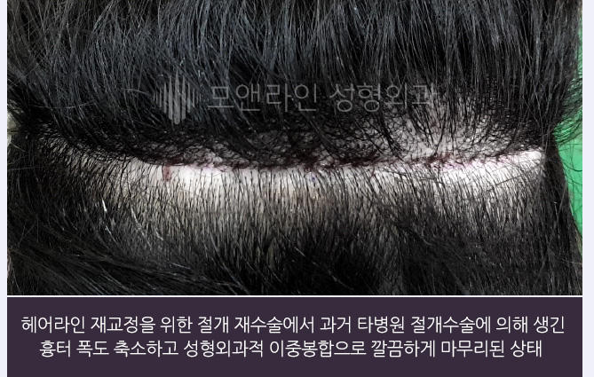 헤어라인 재교정을 위한 절개 재수술에서 과거 타병원 절개수술에 의해 생긴 흉터 폭도 축소하고 성형외과적 이중봉합으로 깔끔하게 마무리된 상태