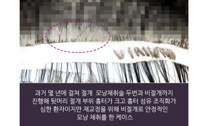 과거 몇 년에 걸쳐 절개  모낭채취술 두번과 비절개까지 진행해 뒷머리 절개 부위 흉터가 크고 흉터 섬유 조직화가 심한 환자이지만 재교정을 위해 비절개로 안정적인 모낭 채취를 한 케이스