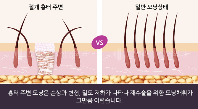 흉터 주변 모낭은 손상과 변형, 밀도 저하가 나타나 재수술을 위한 모낭채취가 그만큼 어렵습니다.