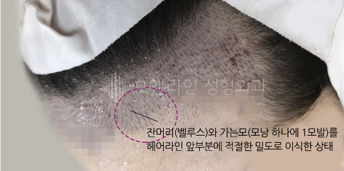 잔머리(벨루스)와 가는모(모낭 하나에 1 모발)를 헤어라인 앞부분에 적절한 밀도로 이식한 상태