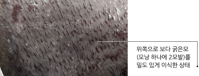 위쪽으로 보다 굵은모(모낭 하나에 2모발)를 밀도 있게 이식한 상태